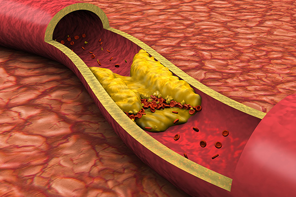 Image representing CHOLESTEROL ADVICE